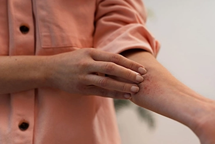 Ticks: The tiny pests with big health risks