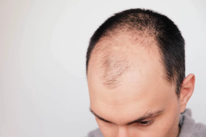 Understanding Hair Loss Causes in Young Males