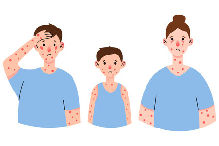 Scalp Psoriasis