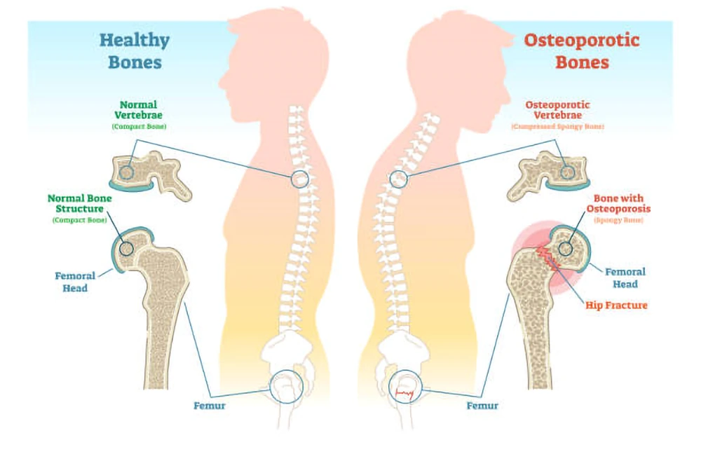 Osteoporosis